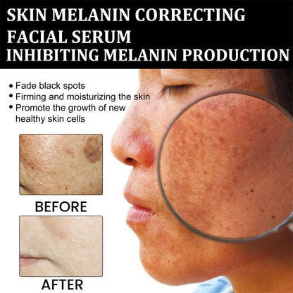 ✨Fast Dark Spot Remover-YAGOO™  Melanin Correcting Facial Serum(🔥Last Day Promotion 60% OFF)