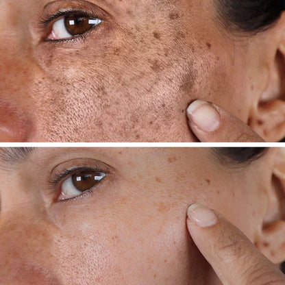 ✨Fast Dark Spot Remover-YAGOO™  Melanin Correcting Facial Serum(🔥Last Day Promotion 60% OFF)
